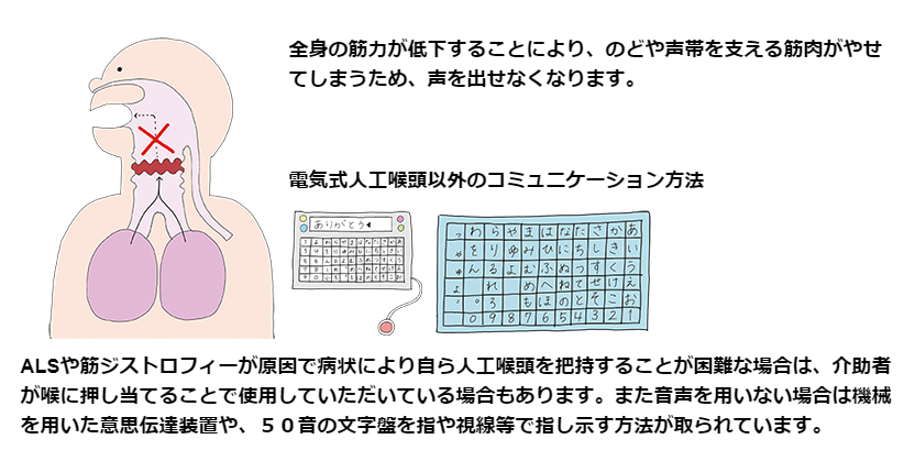 気管切開の模式図