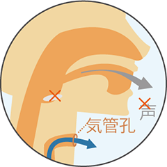 喉頭がん等による喉頭摘出